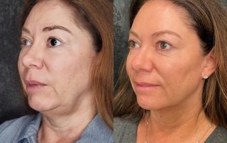 before-after-rejuvenate528-02